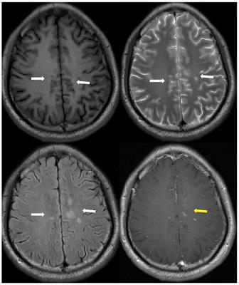 Clinical Features and Imaging Findings of Myelin Oligodendrocyte Glycoprotein-IgG-Associated Disorder (MOGAD)
